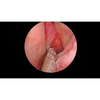 2,7 mm Sinoscopio
